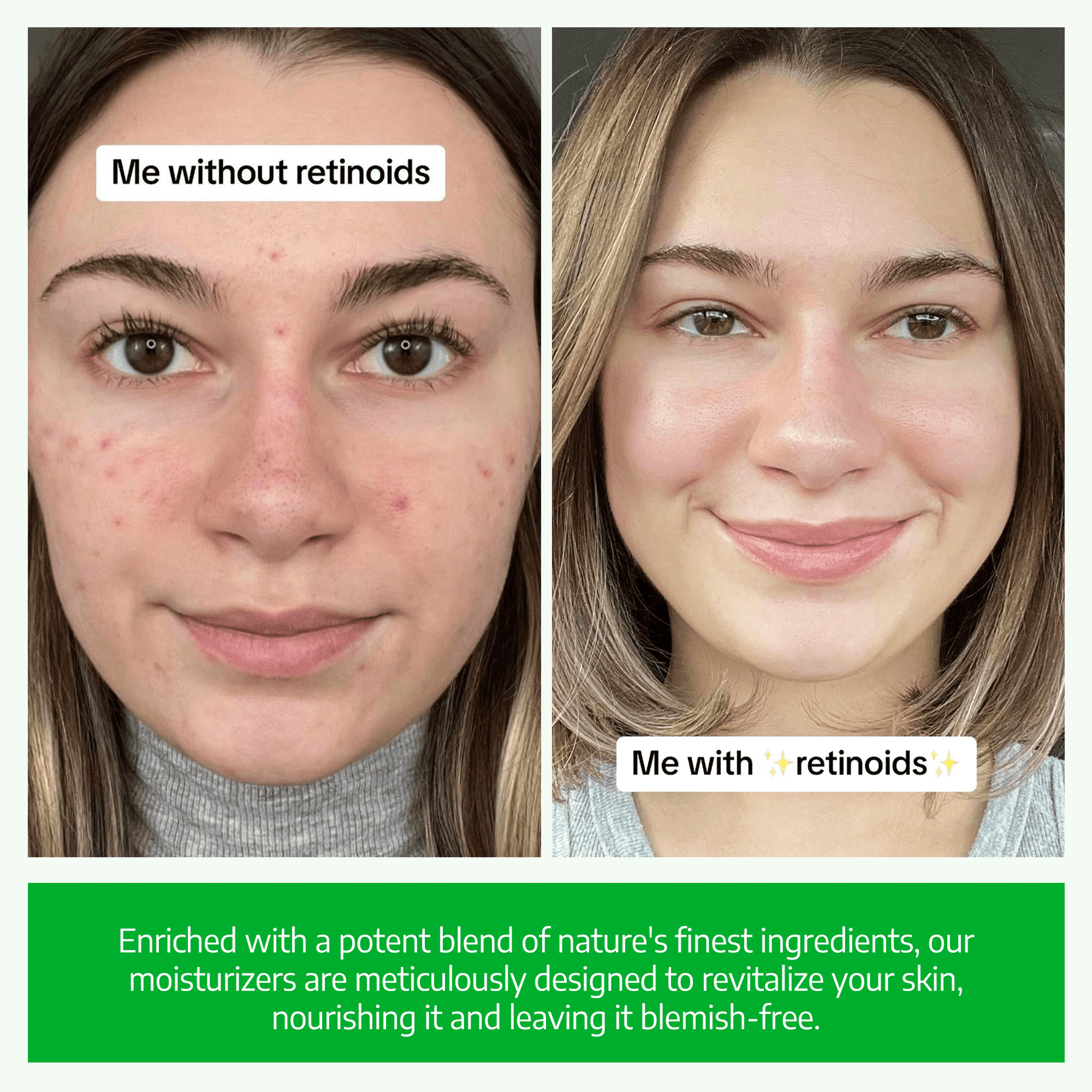 Before and after using organic retinol face cream: A woman with clearer, smoother, and revitalized skin. Enriched with a potent blend of nature's finest ingredients, our moisturizer is designed to boost collagen, diminish wrinkles, and enhance skin clarity for a radiant complexion